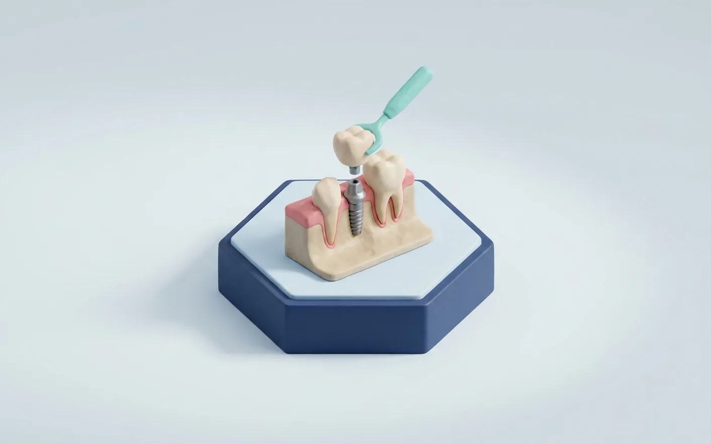 Implantologia dentale a Montecatini Terme
